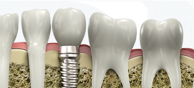 dental implants pasadena