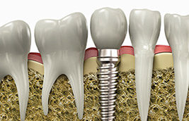 Teeth Replacement with Dental Implants