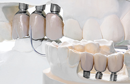 How to Look After your Implants and Dentures?