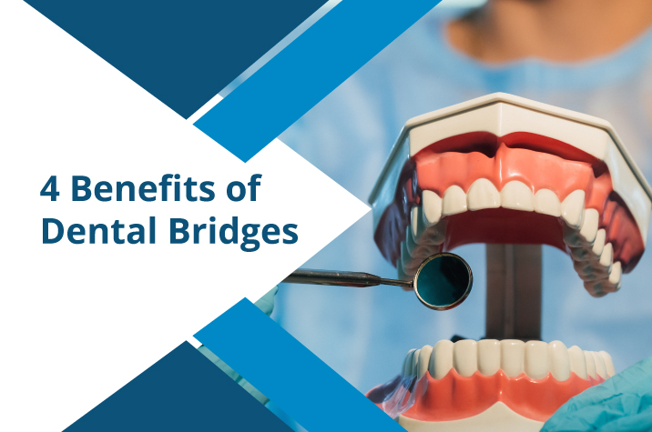 4 Benefits of Dental Bridges