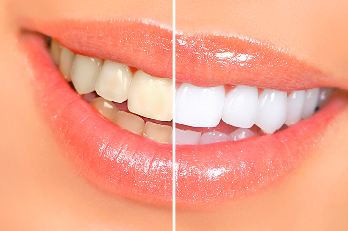 Why Do Teeth Become Stained?