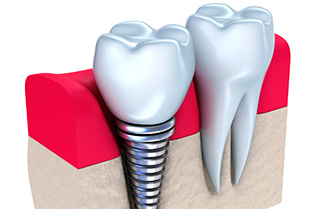Does Dental Implant Treatment Hurt?