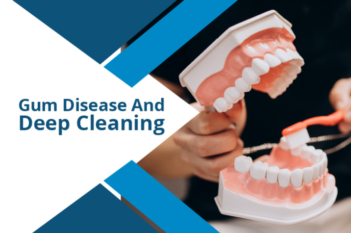 Gum Disease And Deep Cleaning (Scaling And Root Planing)