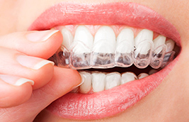 Six Reasons Why You Should Get Invisalign