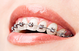 Tips to Ease the Pain of Braces
