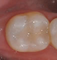 Tooth Colored (Composite) Fillings