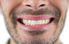 Does a Missing Tooth Need to Be Replaced?