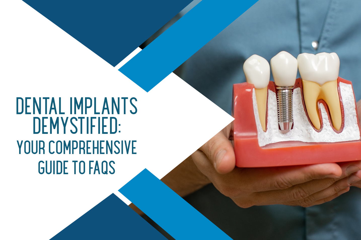 Dental Implants Demystified: Your Comprehensive Guide to FAQs