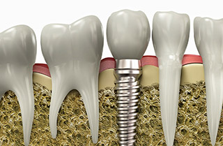 How Can I Replace My Missing Teeth with Dental Implants?