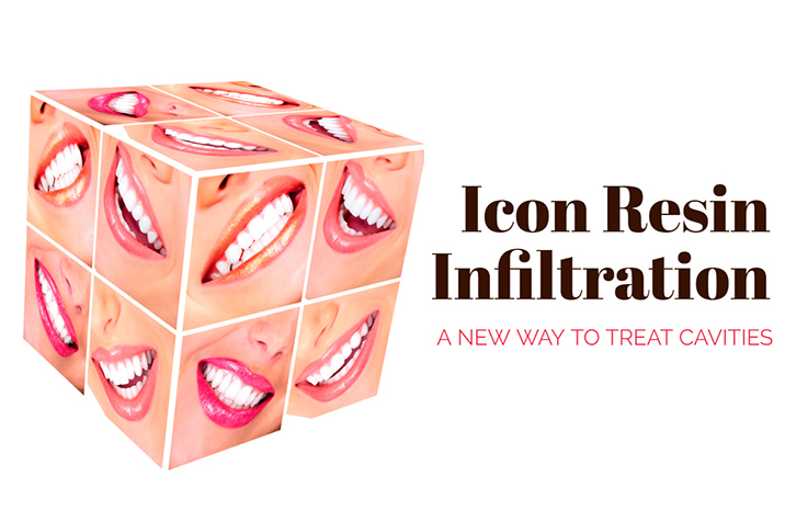 Icon Resin Infiltration: A New Way to Treat Cavities