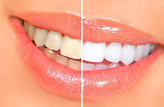 What Causes Tooth Stains and How to Get Rid of Them