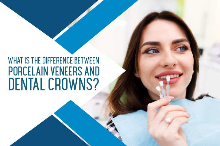 What Is The Difference Between Porcelain Veneers and Dental Crowns?