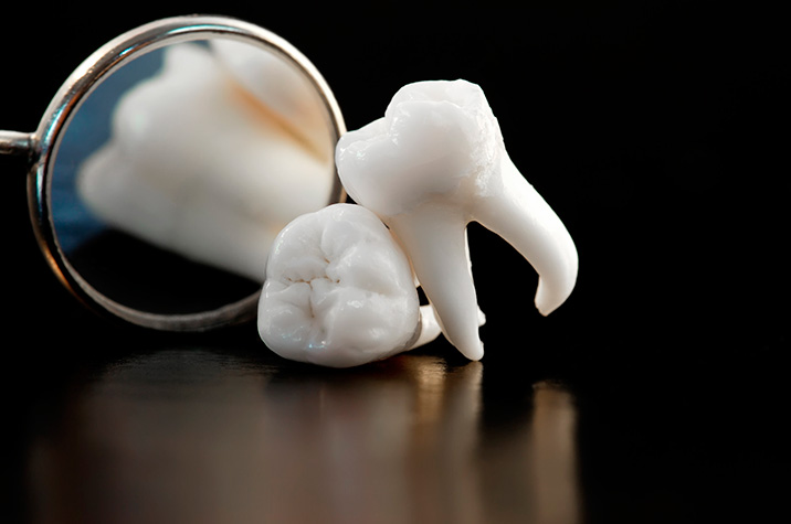 Wisdom Teeth: In or Out? Pasadena Dentist Explains the Pros and Cons of Extraction
