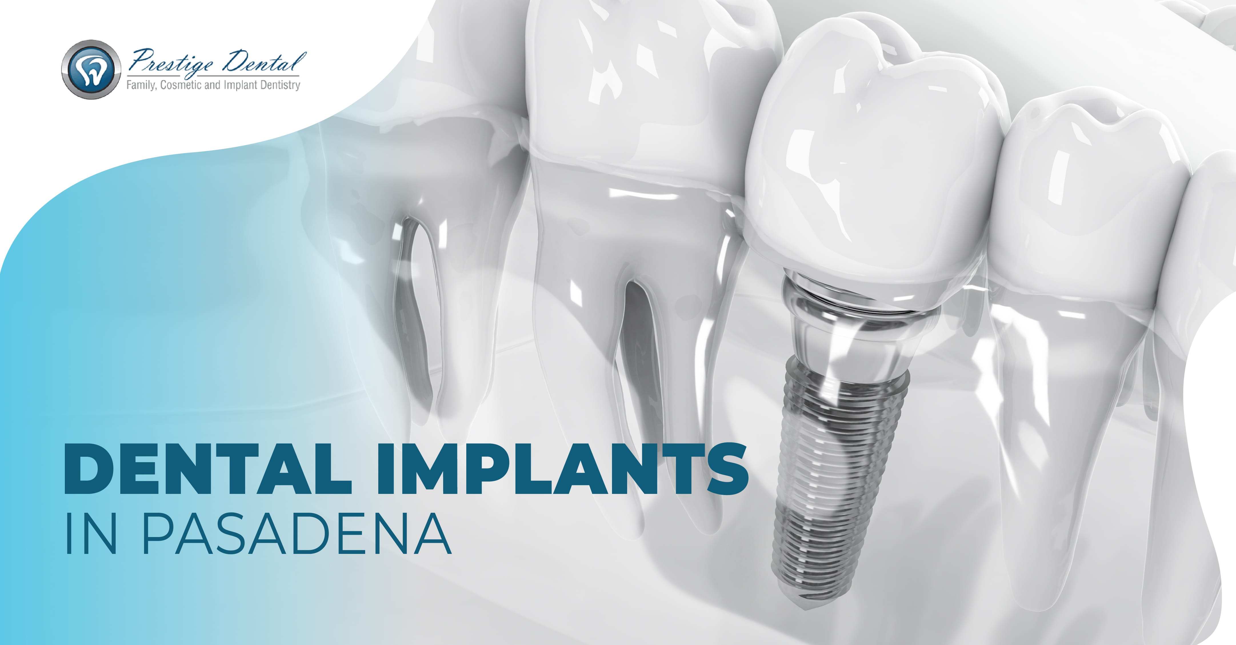 Pasadena Dental Implants Implants for Missing Teeth Pasadena