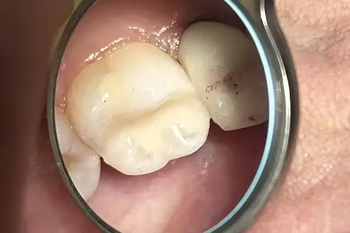 Tooth restored after Papacarie Duo treatment by Dr. Bouzoghlanian at Prestige Dental Pasadena.