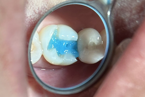 Application of Papacarie Duo gel by Dr. Doudian. The blue gel selectively softens decayed tooth structure, allowing removal in a minimally invasive way and reducing the need for extensive drilling.