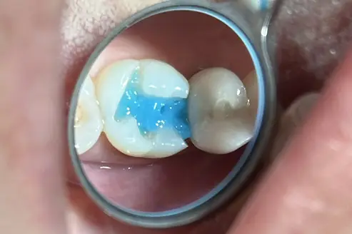 Application of Papacarie Duo gel by Dr. Bouzoghlanian. The blue gel selectively softens decayed tooth structure, allowing removal in a minimally invasive way and reducing the need for extensive drilling.
