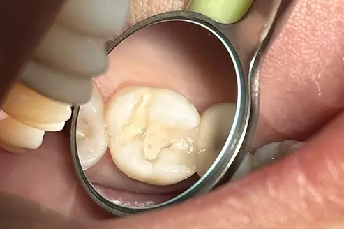 Dr. Bouzoghlanian examining a molar with an old, broken filling before Papacarie Duo treatment.