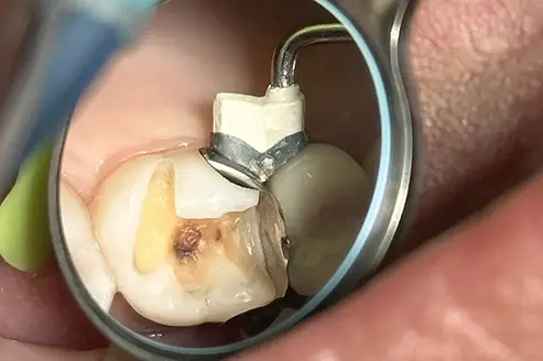 Tooth after Papacarie Duo decay removal, showing preserved healthy tooth structure.