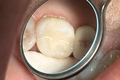 Final restoration completed with Papacarie Duo treatment by Dr. Doudian. The tooth shows a clean, natural, and aesthetic finish achieved through minimally invasive dentistry.
