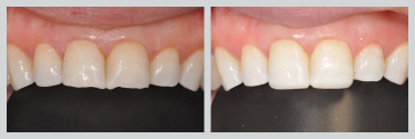 Before and After Bonding 15