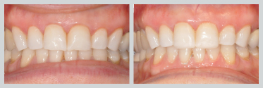 Before and After Bonding 15