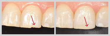 Before and After Composite Bonding 17 #01