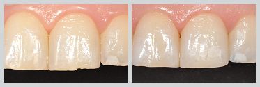Before and After Composite Bonding 17 #02