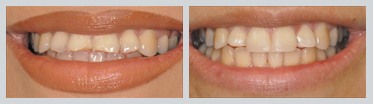 Before and After Composite Bonding Case 20