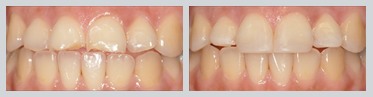 Before and After Composite Bonding Case 20