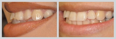 Before and After Composite Bonding Case 20