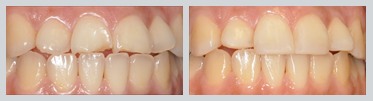 Before and After Composite Bonding Case 20