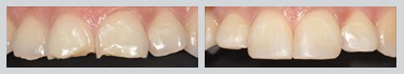 Before and After Composite Bonding Case 20