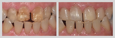 Before and After White (Composite) Fillings