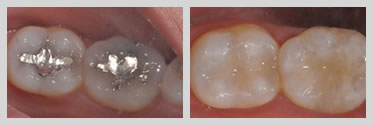 Before and After White (Composite) Fillings