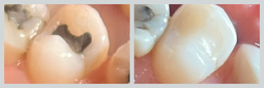 Before and After White (Composite) Fillings 07