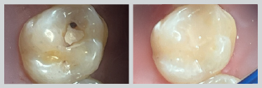 Before and After White (Composite) Fillings 08