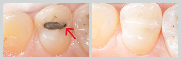 Before and After White (Composite) Fillings 09