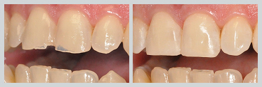 Before and After White (Composite) Fillings Case 10