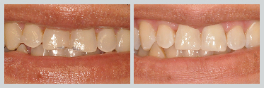 Before and After White (Composite) Fillings Case 10