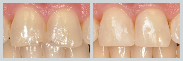 Before and After White (Composite) Fillings Case 10