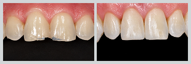 Before and After White (Composite) Fillings Case 10