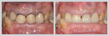 Before and After Crowns 08