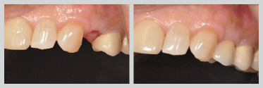 Before and After Dental Implants 08
