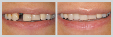 Before and After Dental Implants 9