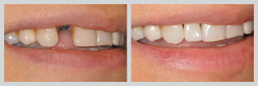 Before and After Dental Implants 10