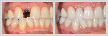 Before and After Dental Implants 12