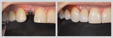 Before and After Dental Implants 13