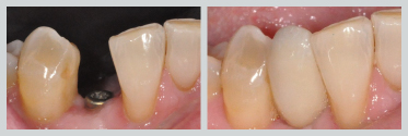 Before and After Dental Implants 14