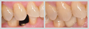 Before and After Dental Implants 15